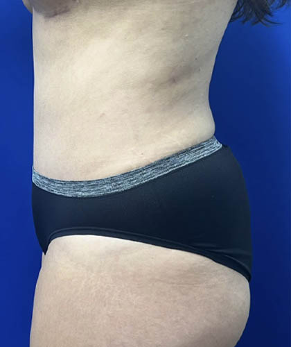 Tummy Tuck case #11330
