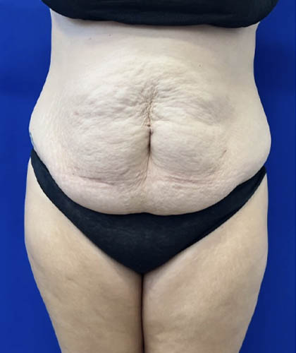 Tummy Tuck case #11340