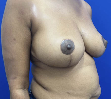 Breast Lift case #11266