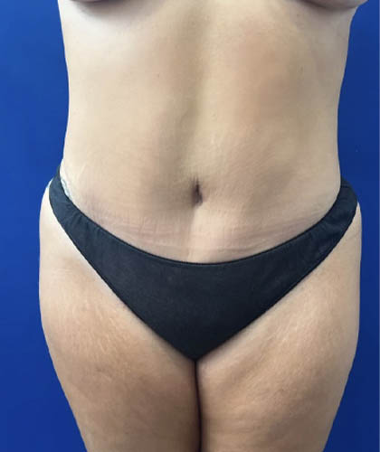 Tummy Tuck case #11340