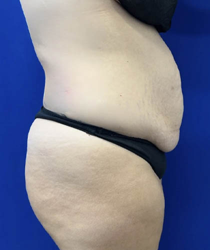 Tummy Tuck case #11340