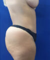 Tummy Tuck case #11340