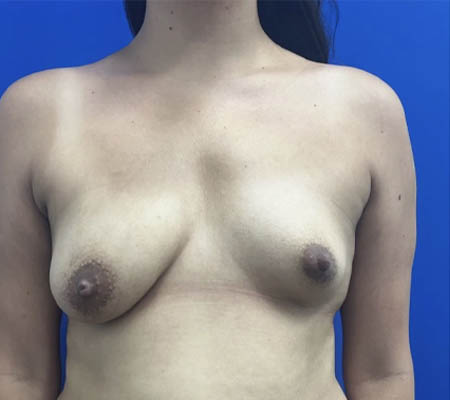 Breast Implants and Lift case #11288