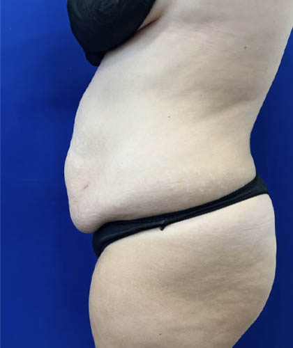 Tummy Tuck case #11340