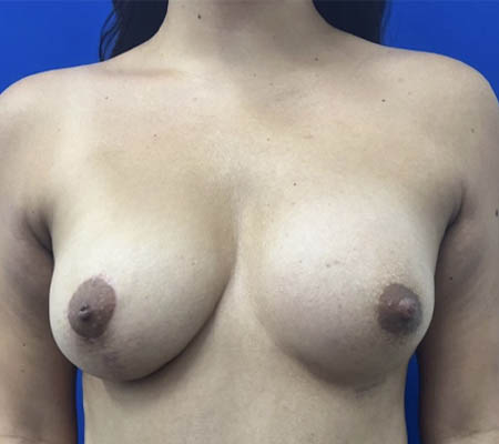 Breast Implants and Lift case #11288