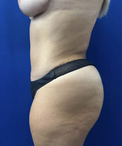 Tummy Tuck case #11340