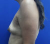 Breast Implants and Lift case #11288