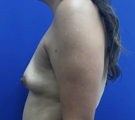 Breast Implants and Lift case #11288