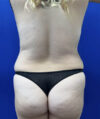 Tummy Tuck case #11340