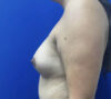 Breast Implants and Lift case #11288