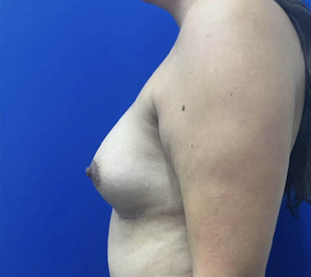 Breast Implants and Lift case #11288