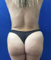 Tummy Tuck case #11340