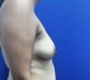 Breast Implants and Lift case #11288