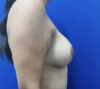 Breast Implants and Lift case #11288