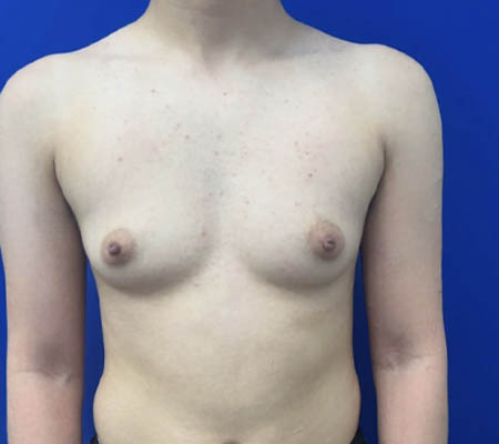 Female To Male case #11310