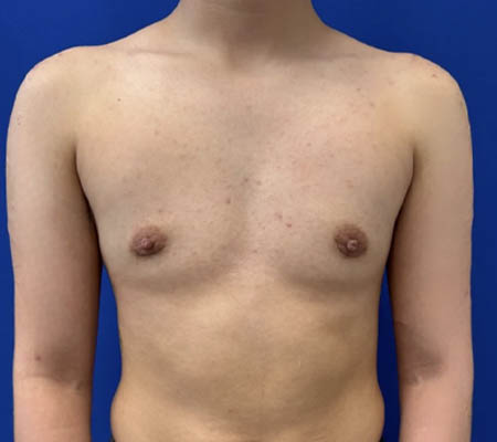 Female To Male case #11310