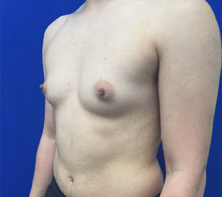 Female To Male case #11310