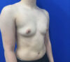Female To Male case #11310