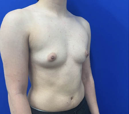 Female To Male case #11310
