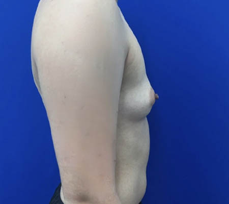Female To Male case #11310