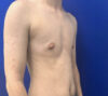 Female To Male case #11265