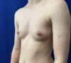 Female To Male case #11265