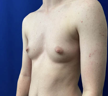 Female To Male case #11265