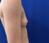 Female To Male case #11265