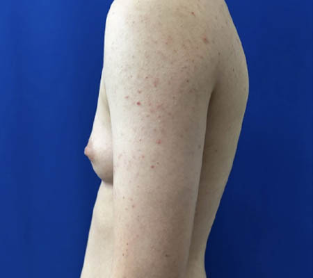 Female To Male case #11265