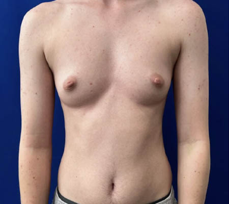 Female To Male case #11265