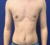 Female To Male case #11265
