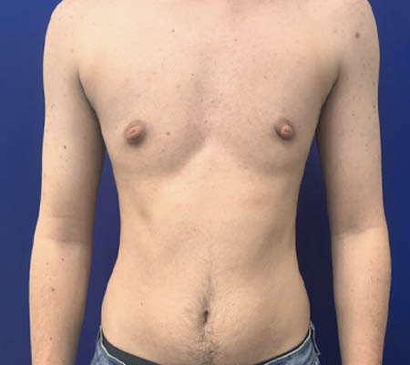 Female To Male case #11265