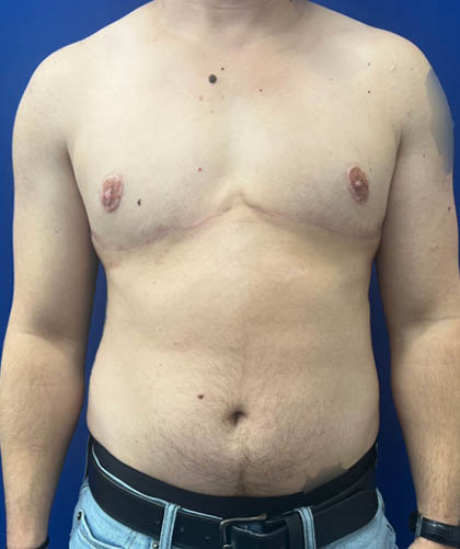 FTM Double incision with nipple grafts case #13545