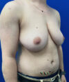 FTM Double incision with nipple grafts case #13545