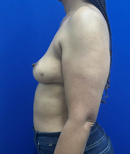 Fat Transfer to the Breasts - American Breast Lift™ ABL case #13784