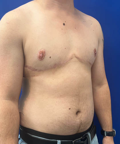 FTM Double incision with nipple grafts case #13545