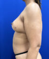 Fat Transfer to the Breasts - American Breast Lift™ ABL case #13784
