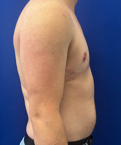 FTM Double incision with nipple grafts case #13545