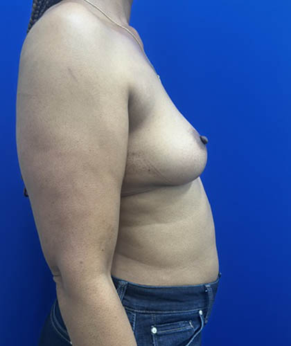 Fat Transfer to the Breasts - American Breast Lift™ ABL case #13784
