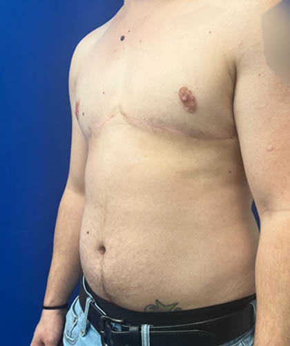FTM Double incision with nipple grafts case #13545