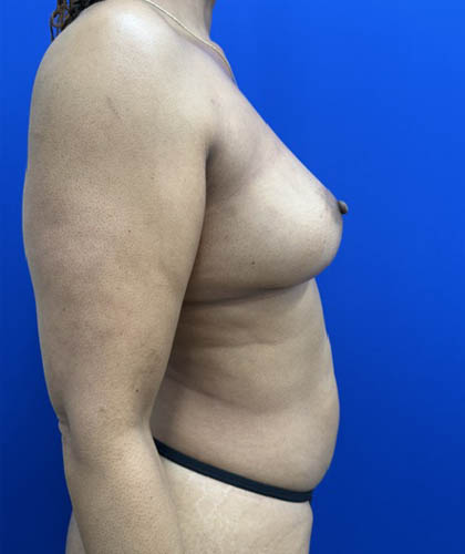 Fat Transfer to the Breasts - American Breast Lift™ ABL case #13784