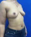 Fat Transfer to the Breasts - American Breast Lift™ ABL case #13784
