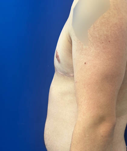 FTM Double incision with nipple grafts case #13545