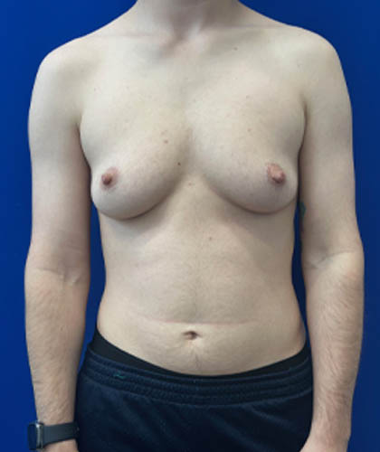 FTM Double incision with nipple grafts case #13763