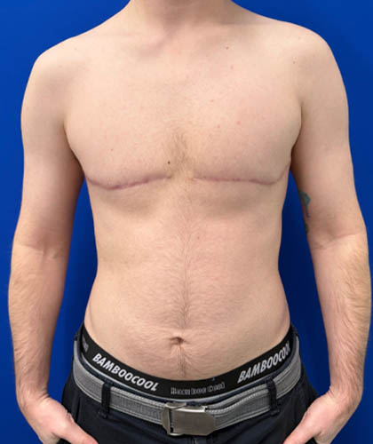 FTM Double incision with nipple grafts case #13763