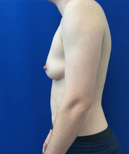 FTM Double incision with nipple grafts case #13763