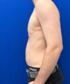 FTM Double incision with nipple grafts case #13763