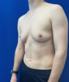 FTM Double incision with nipple grafts case #13763