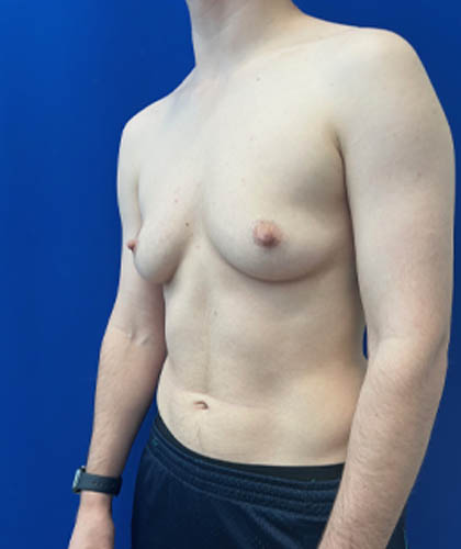 FTM Double incision with nipple grafts case #13763