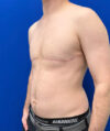 FTM Double incision with nipple grafts case #13763